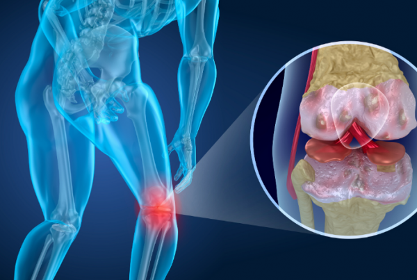 Foto ilustrativa de osteoartrose primária em joelho