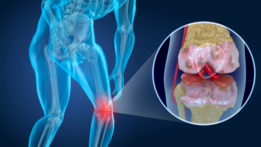 Foto ilustrativa de osteoartrose primária em joelho