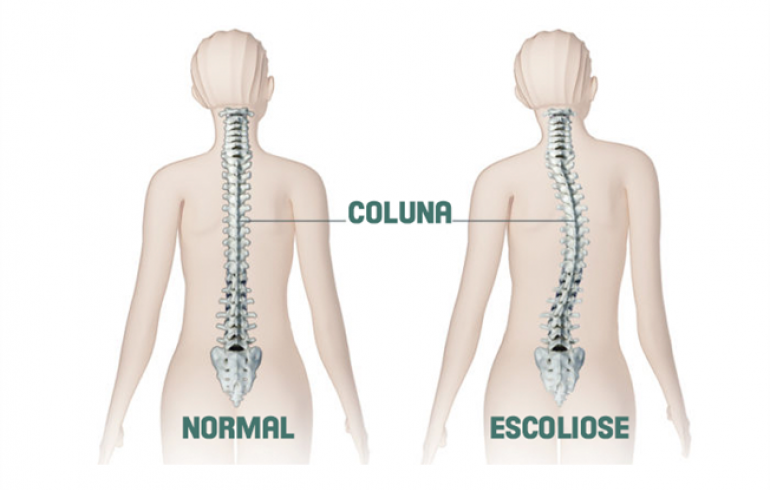paciente com escoliose na coluna vertebral